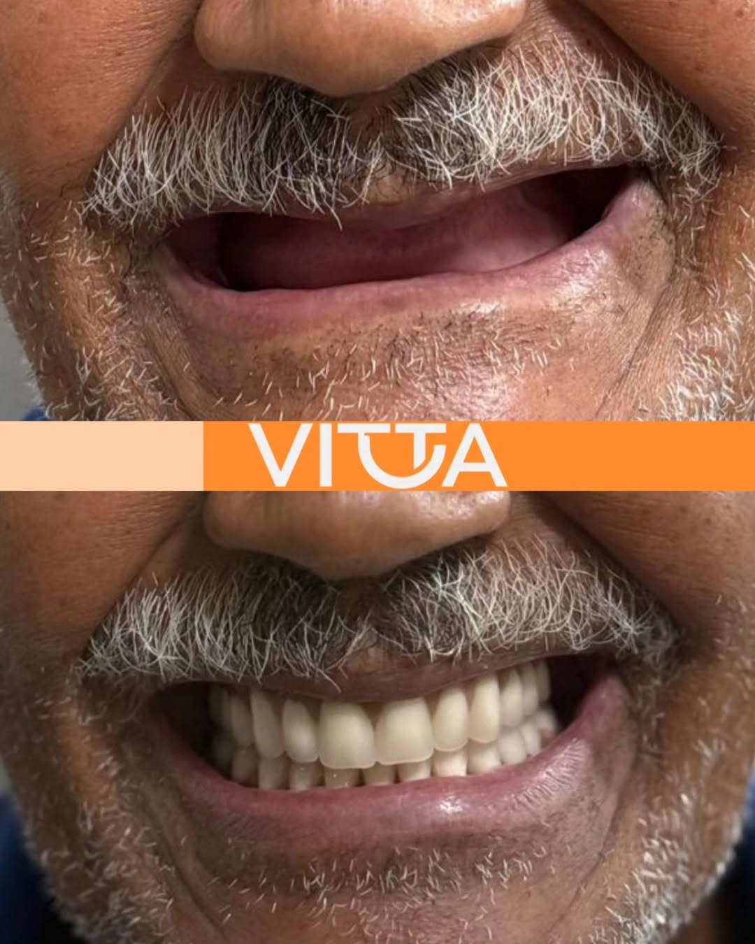 Antes e Depois - Vitta Odontologia