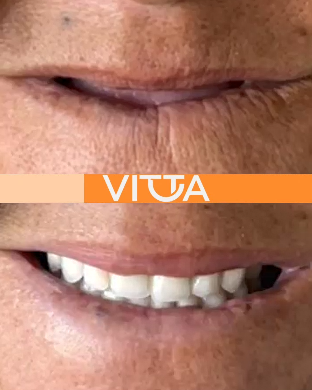 Sorriso planejado individualmente - Vitta