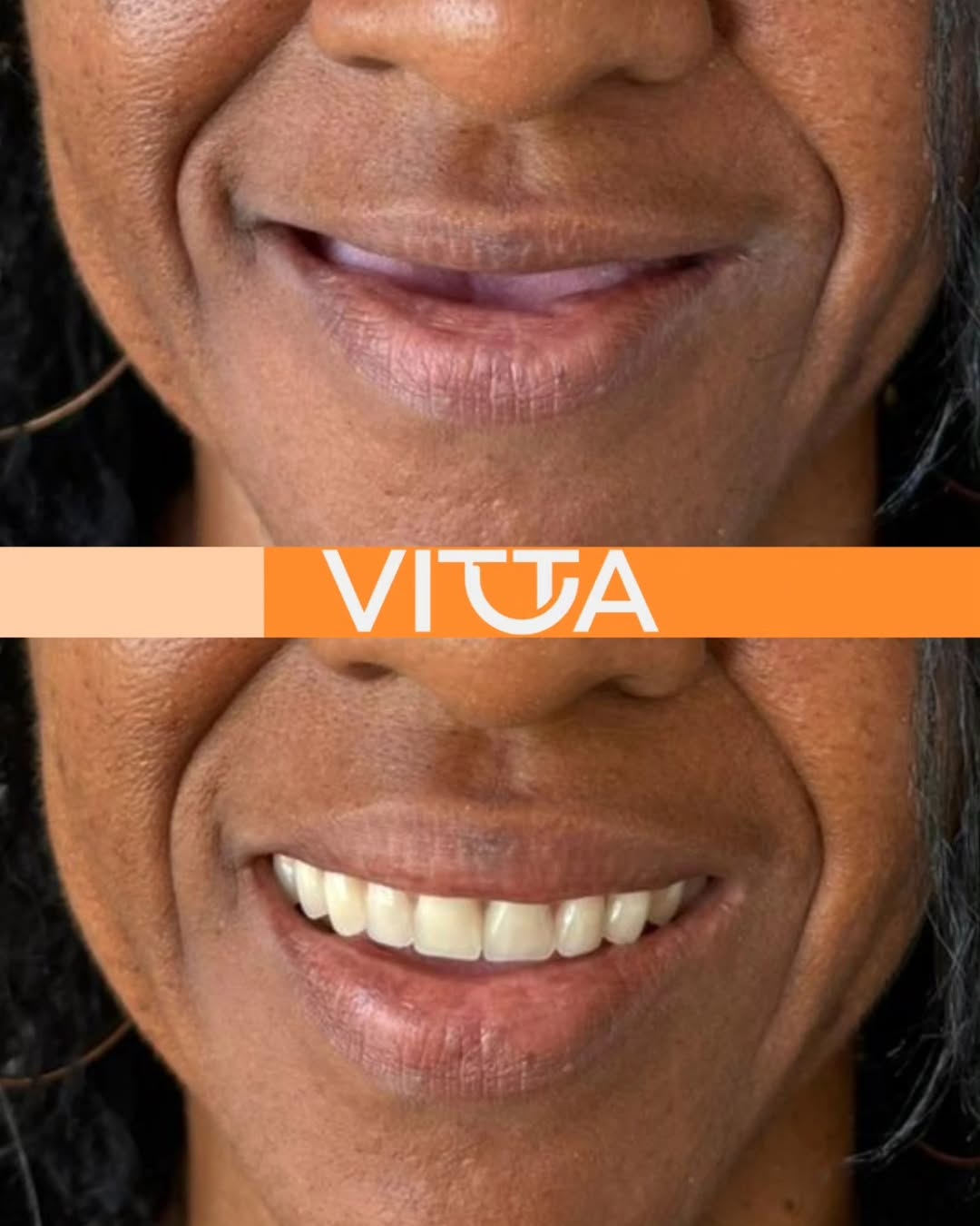 Sorriso planejado individualmente - Vitta